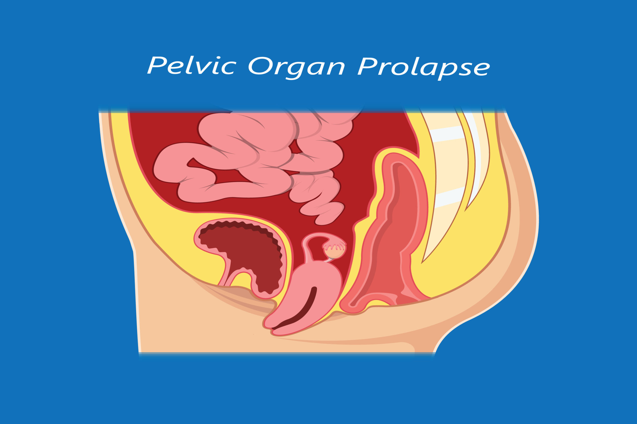 Pelvic Image Prolapse